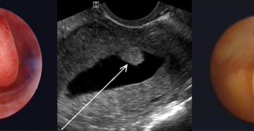 Лечение после удаления полипа эндометрия в постменопаузе