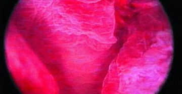 Гиперплазия эндометрия, гистероскопия