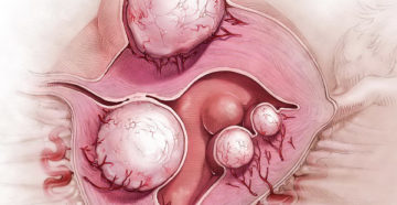 Миома, грудь болит беременность ли это