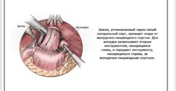 Питание после лапароскопической фундопликации