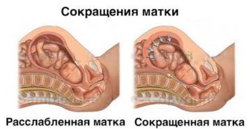 Тонус матки без боли и выделений