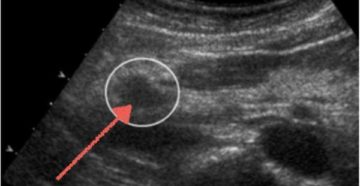 Пониженная эхогенность плаценты