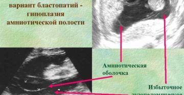 Гипоплазия амниотической полости помогите расшифровать ущи