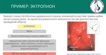 Диагноз эрозированный эктропион при беременности Диагноз эрозированный эктропион при беременности