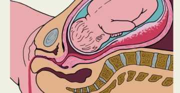 Отслойка плаценты, не останавливается кровь