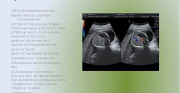 Персистенция правой пупочной вены