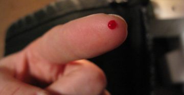 Уколола палец случайно иголкой, предположительно ВИЧ инфицированного