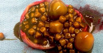 Камень в желчном пузыре удалять или жить с ним?