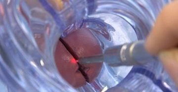 Последствия после прижигании эрозии аргоном