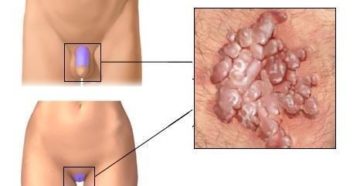 Твердые половые губы