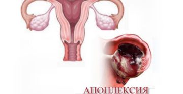 Беременность после апоплексии яичника Беременность после апоплексии яичника