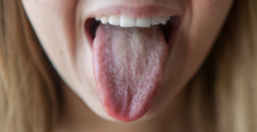 Белый налет и шершавость на языке