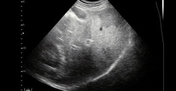 Жировой гепатоз, расшифровка УЗИ