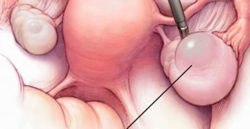 Эндометриозная киста уменьшилась Эндометриозная киста уменьшилась