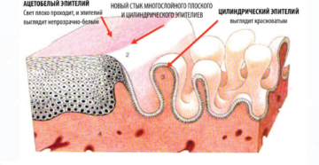 Ацето белый эпителий