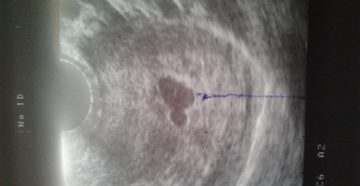 Два плодных яйца