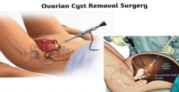 Стимуляция клитора после удаления кисты яичника