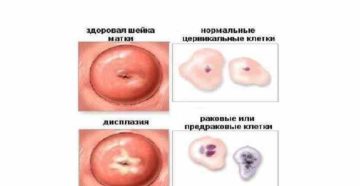 Образование на шейке матки ввиде прыщика