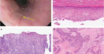 Клетки плоского эпителия с признаками дискератоза