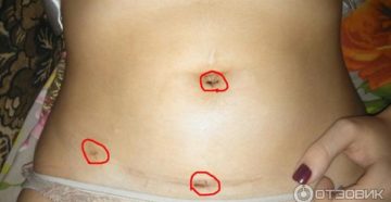 Выделения после лапороскопии Выделения после лапороскопии