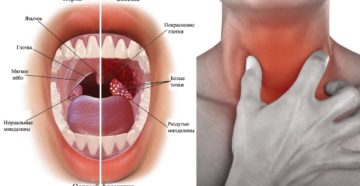 Болит горло внутри Болит горло внутри